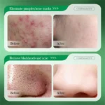 Pore Cleaning Soap Anti-Acne Shrink Pores Deep Remove Blackheads Chicken Skin Oil Control Moisturizer whitening Smooth Skin