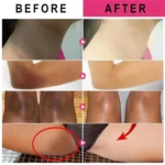 Whitening Cream For Dark Skin Underarm Bleaching Armpit Lightening And Intimate Area Woman Moisturizer Korean Skin Care