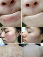 Pore Cleaning Soap Anti-Acne Shrink Pores Deep Remove Blackheads Chicken Skin Oil Control Moisturizer whitening Smooth Skin